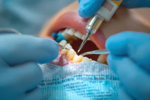 Odontología restauradora mínimamente invasiva